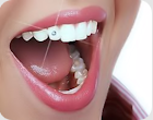 Bijuterii dentare